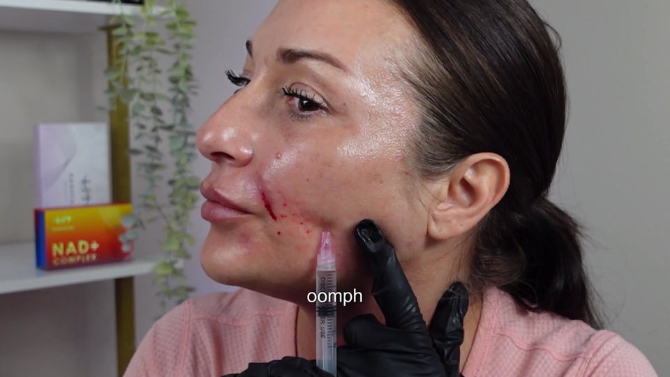 Meso PDRN and Exosomes-